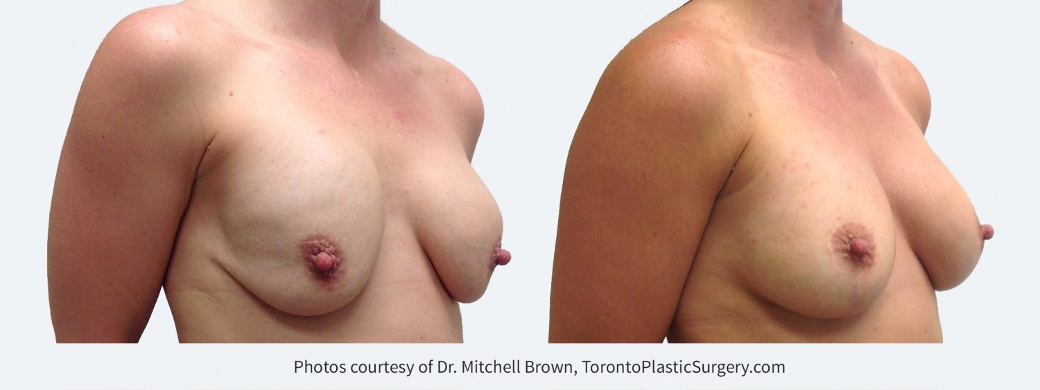 Superior malposition of both implants (implants too high) with sagging of the overlying breast tissue. Correction was performed by inserting new implants in a lower position and by performing a breast lift with incisions placed around the areola and vertically down the breast. Before and 1 year after