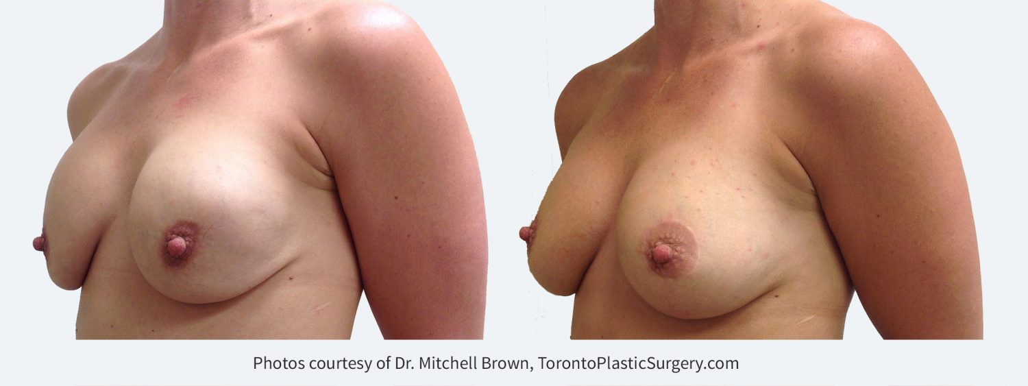 Superior malposition of both implants (implants too high) with sagging of the overlying breast tissue. Correction was performed by inserting new implants in a lower position and by performing a breast lift with incisions placed around the areola and vertically down the breast. Before and 1 year after