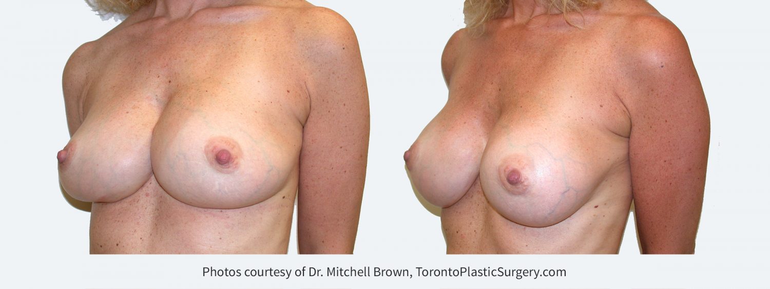 Synmastia (implants too close together). Corrected by placing smaller and narrower implants in a new pocket under the pectoral muscle along with reinforcement of  the medial breast implant pocket. Before and 6 months after