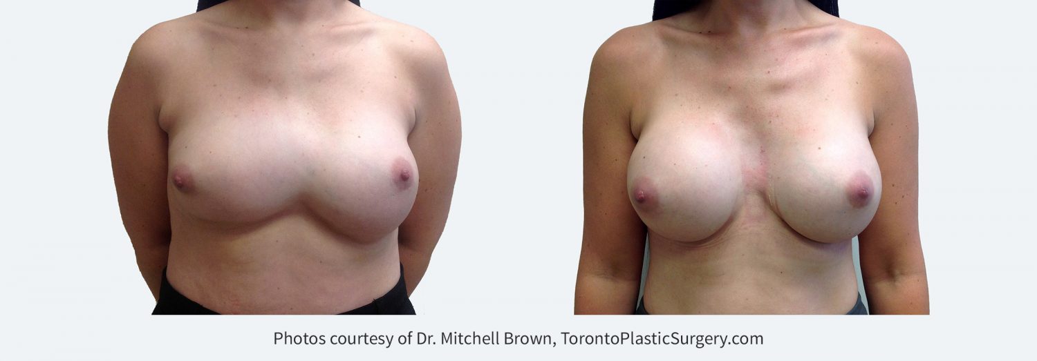 Synmastia (implants too close together). Corrected by placing 365cc implants in a new pocket under the muscle. Before and 6 months after. 