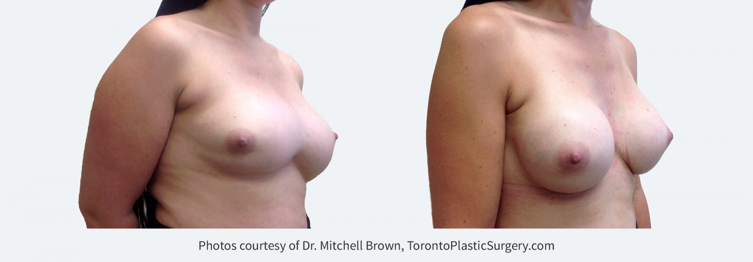 Synmastia (implants too close together). Corrected by placing 365cc implants in a new pocket under the muscle. Before and 6 months after. 