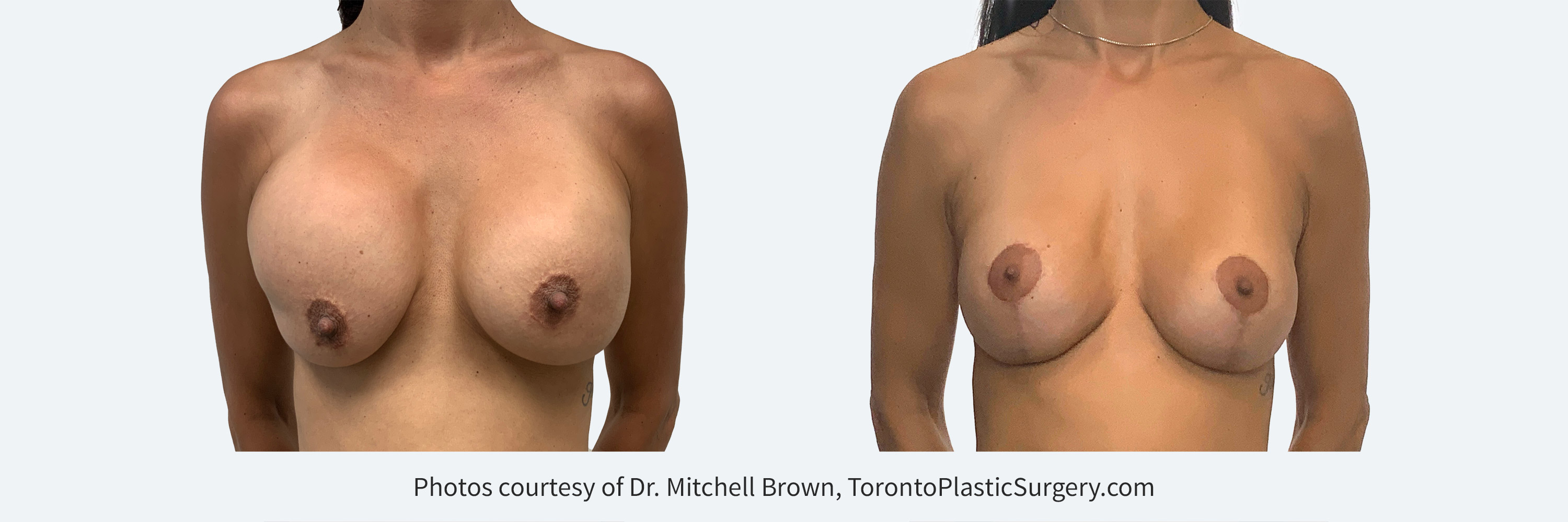 Two previous surgeries with right implant too high under the muscle and left implant contracted. Corrected by repair of each implant pocket, insertion of smaller implants and performing a breast lift. Before and 6 months after.