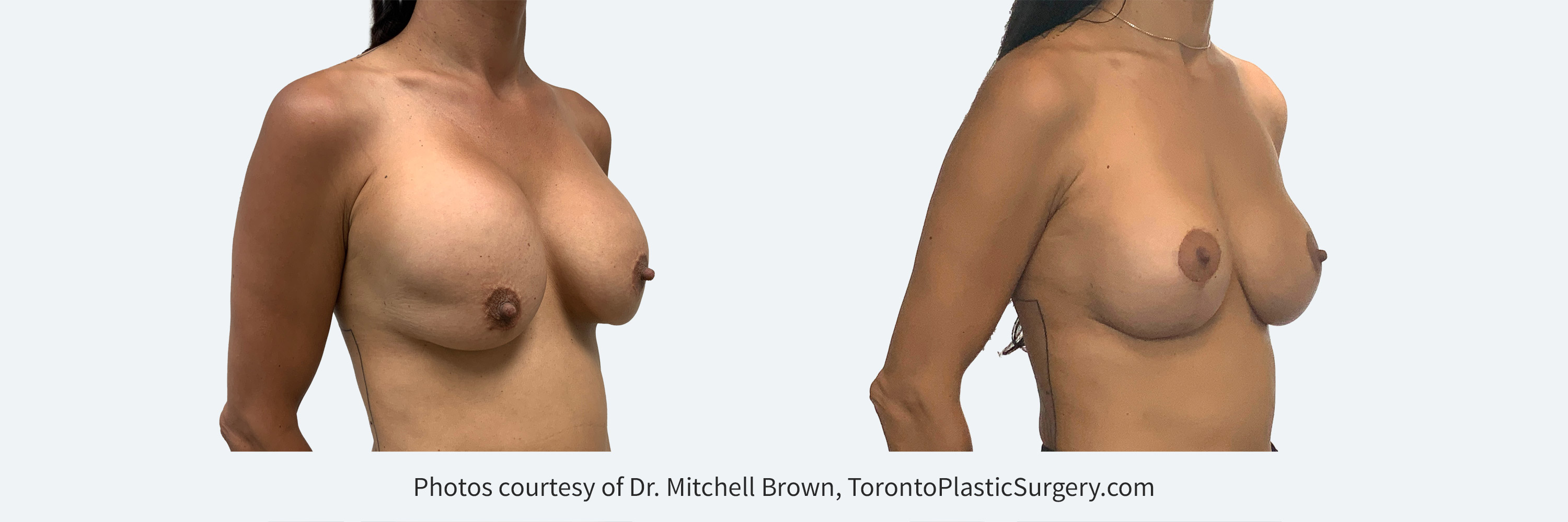 Two previous surgeries with right implant too high under the muscle and left implant contracted. Corrected by repair of each implant pocket, insertion of smaller implants and performing a breast lift. Before and 6 months after.