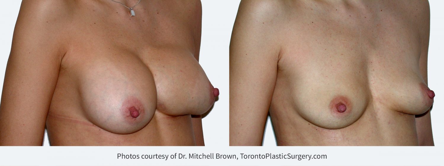 Previous breast augmentation complicated by unrecognized bleeding and shifted implant on the left. Before and 6 months after implant removal