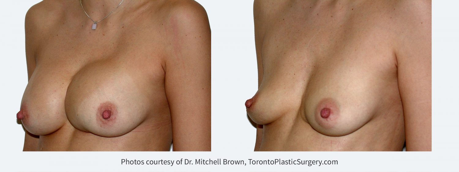 Previous breast augmentation complicated by unrecognized bleeding and shifted implant on the left. Before and 6 months after implant removal