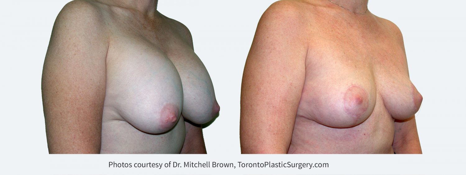 Recurrent capsular contracture and sagging of the breast treated with implant removal and reshaping of the breasts with a breast lift and fat grafting. Before and 6 months after