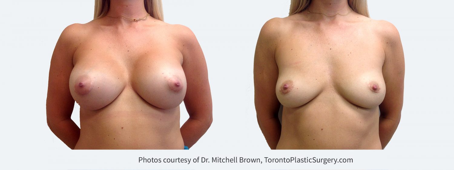 Previous breast augmentation. Patient felt too large and wanted implants removed. Before and 11 months after implant removal and fat grafting of 180cc in each breast.