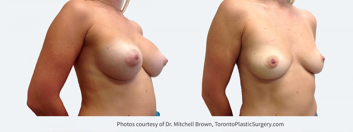 Previous breast augmentation. Patient felt too large and wanted implants removed. Before and 11 months after implant removal and fat grafting of 180cc in each breast.