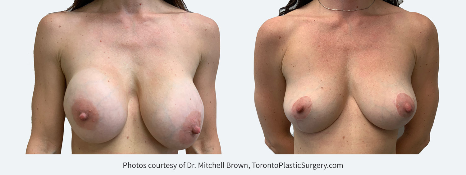 Capsular contracture treated with bilateral implant removal, capsulectomy and reshaping of the breasts with a breast lift and fat grafting. Before and after 1 year.