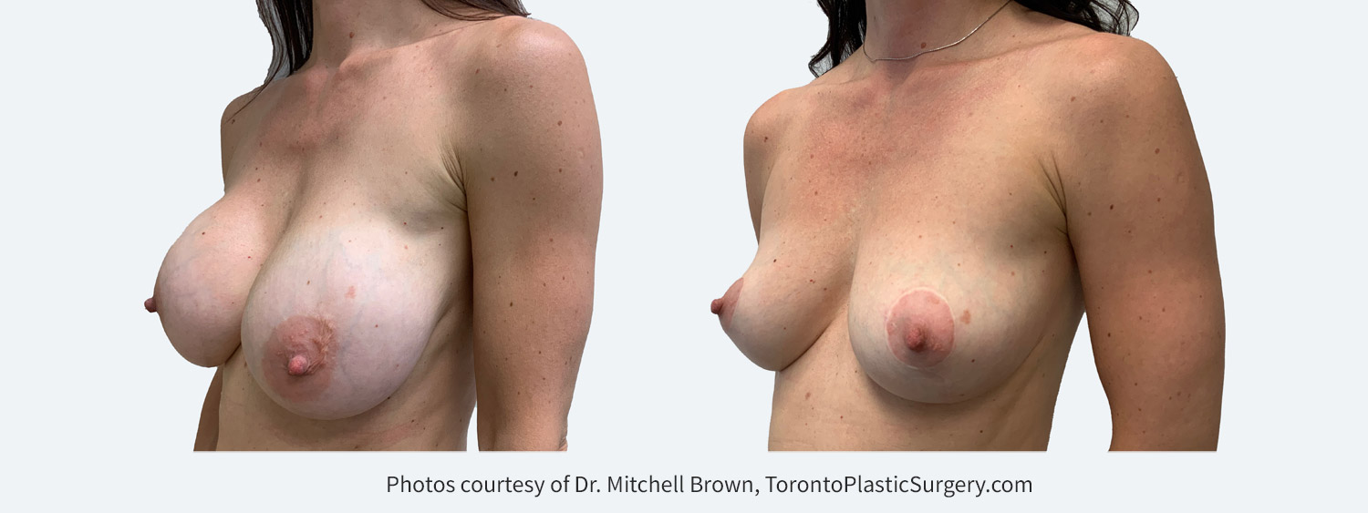 Capsular contracture treated with bilateral implant removal, capsulectomy and reshaping of the breasts with a breast lift and fat grafting. Before and after 1 year.