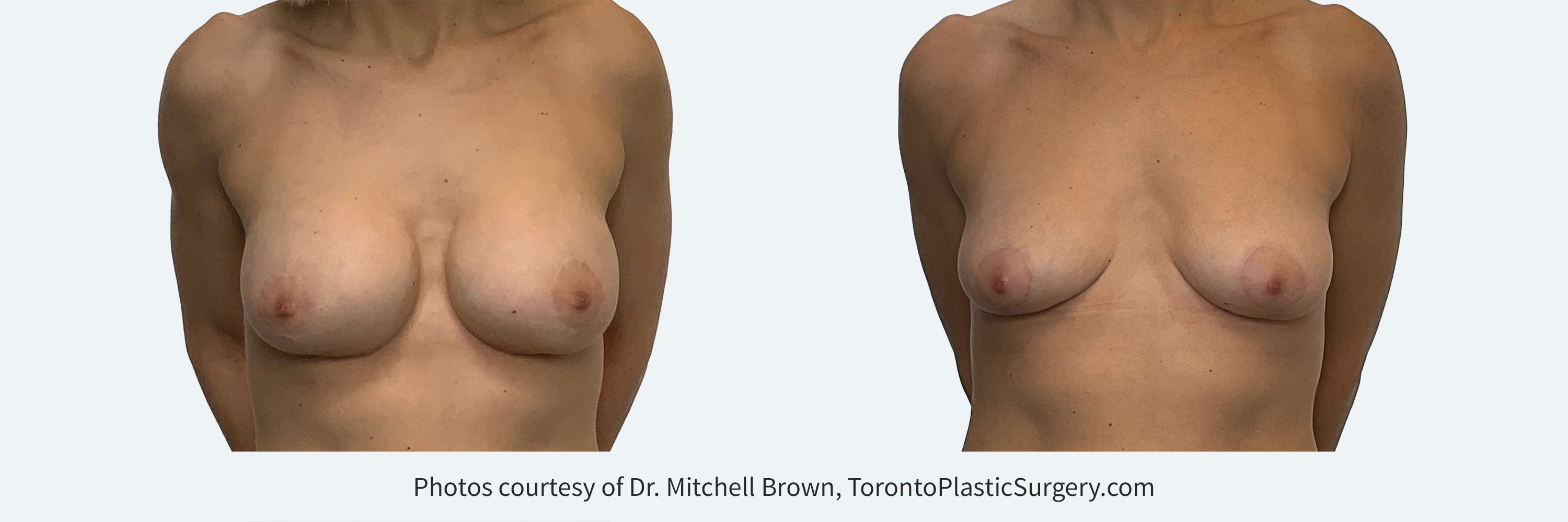 Implants for 9 years and desires removal with breast lift and fat grafting, before and 6 months after