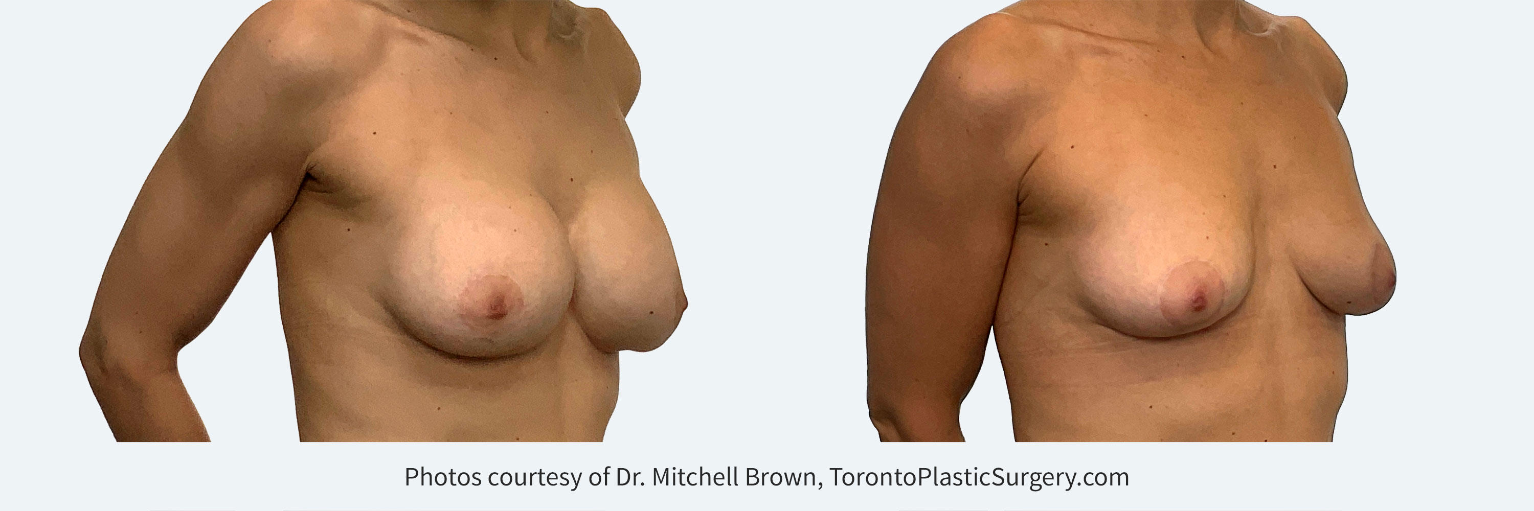 Implants for 9 years and desires removal with breast lift and fat grafting, before and 6 months after