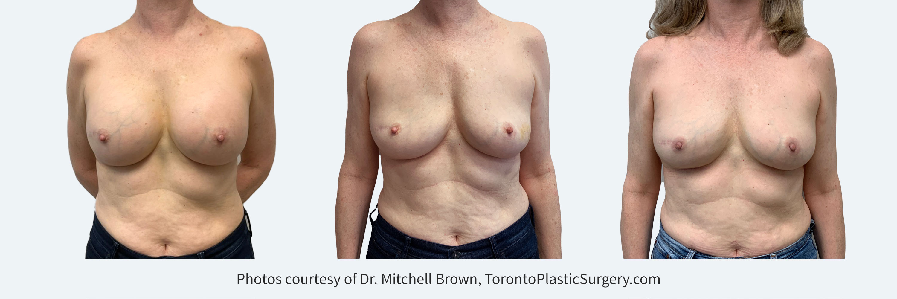 https://www.torontoplasticsurgery.com/wp-content/uploads/implant-removal-8-front2.jpg