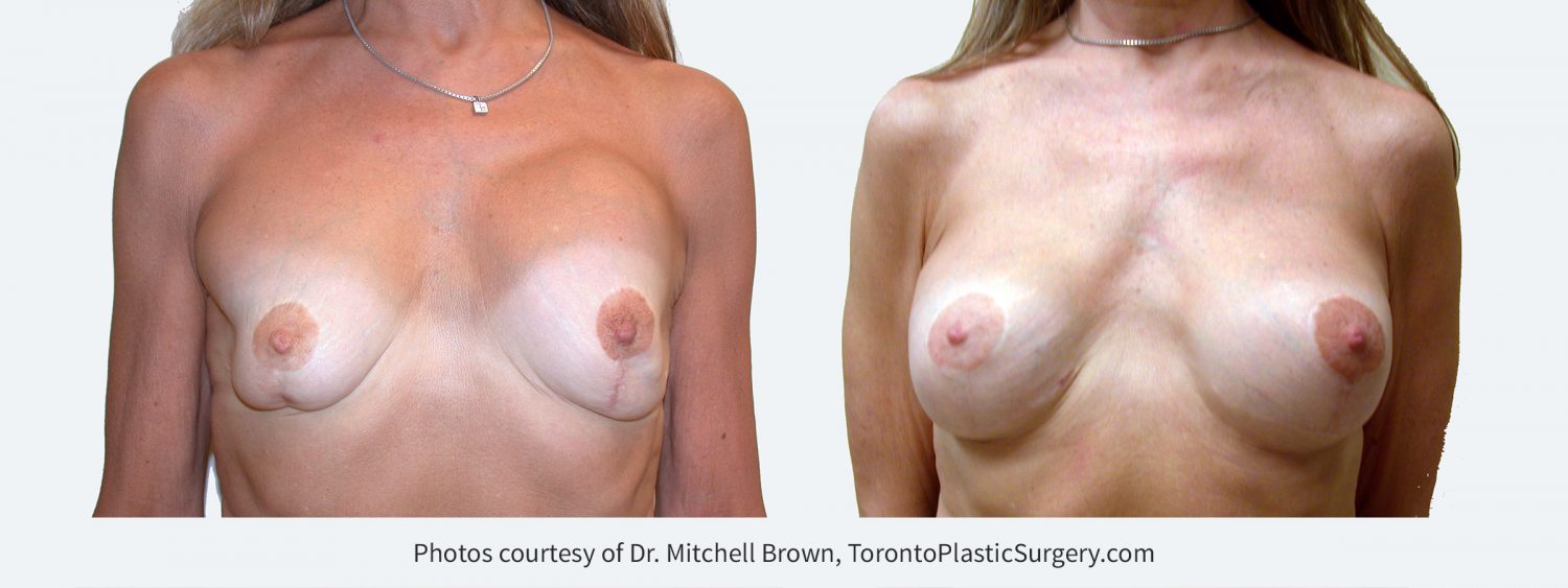 Multiple previous procedures including breast lift, implant replacement and correction of capsular contracture. Now presenting with left breast implant rupture, capsular contracture, severe asymmetry and abnormal breast shape. Treated with implant removal, replacement of new 235 cc silicone gel breast implants under the pectoral muscle and revision of breast lift.  Before and 1 year after