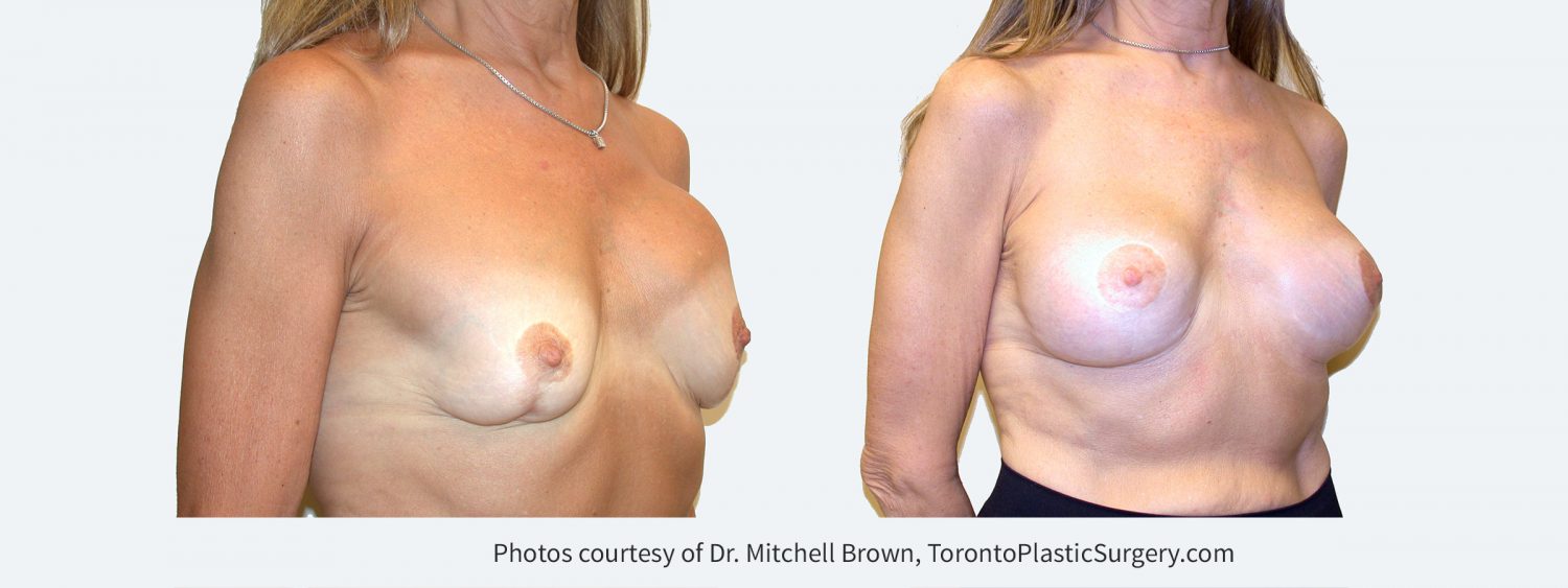 Multiple previous procedures including breast lift, implant replacement and correction of capsular contracture. Now presenting with left breast implant rupture, capsular contracture, severe asymmetry and abnormal breast shape. Treated with implant removal, replacement of new 235 cc silicone gel breast implants under the pectoral muscle and revision of breast lift.  Before and 1 year after