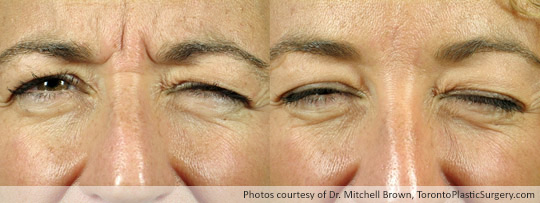 Injectable treatment to stop frowning and prevent an “angry” look, Before and After