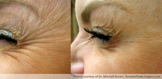 Injectable treatment around the eyes to soften “crow’s feet”, Before and After
