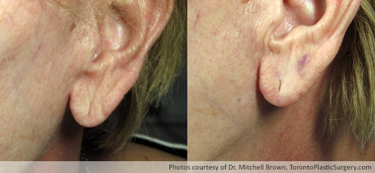 Juvederm: Earlobe rejuvenation, Before and After