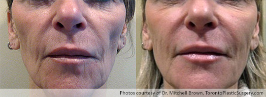 Juvederm: Lower lip enhancement to improve symmetry, Juvederm Ultra Plus for “marionette” lines, Juvederm Voluma to fill out cheek hollows, Before and After