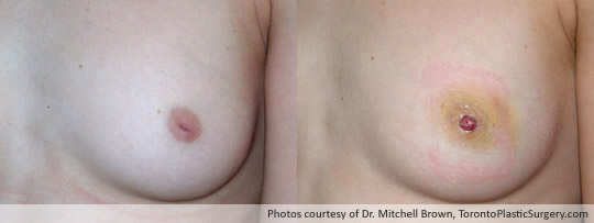 inverted-nipple-case1-closeup