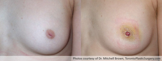 Inverted Nipple Correction, Before and After 4 Days