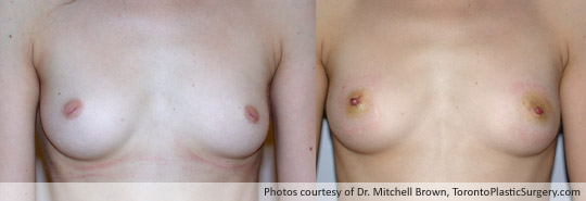 Inverted Nipple Correction, Before and After 4 Days