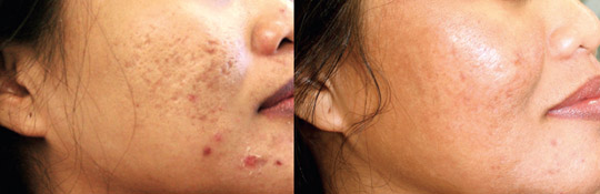 Laser treatment for acne and scars, Before and After