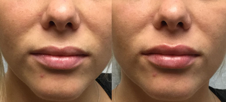 Lip Augmentation, Before and Immediately After
