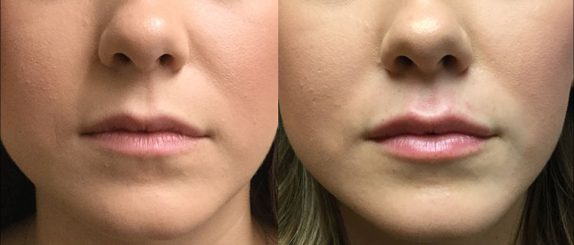 Lip Augmentation, Before and Immediately After