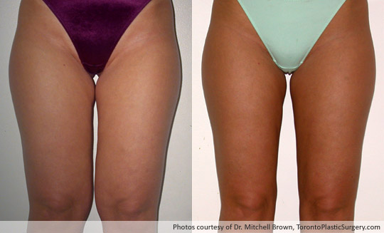 Case 3: Inner Thighs and Knees, After 6 Months