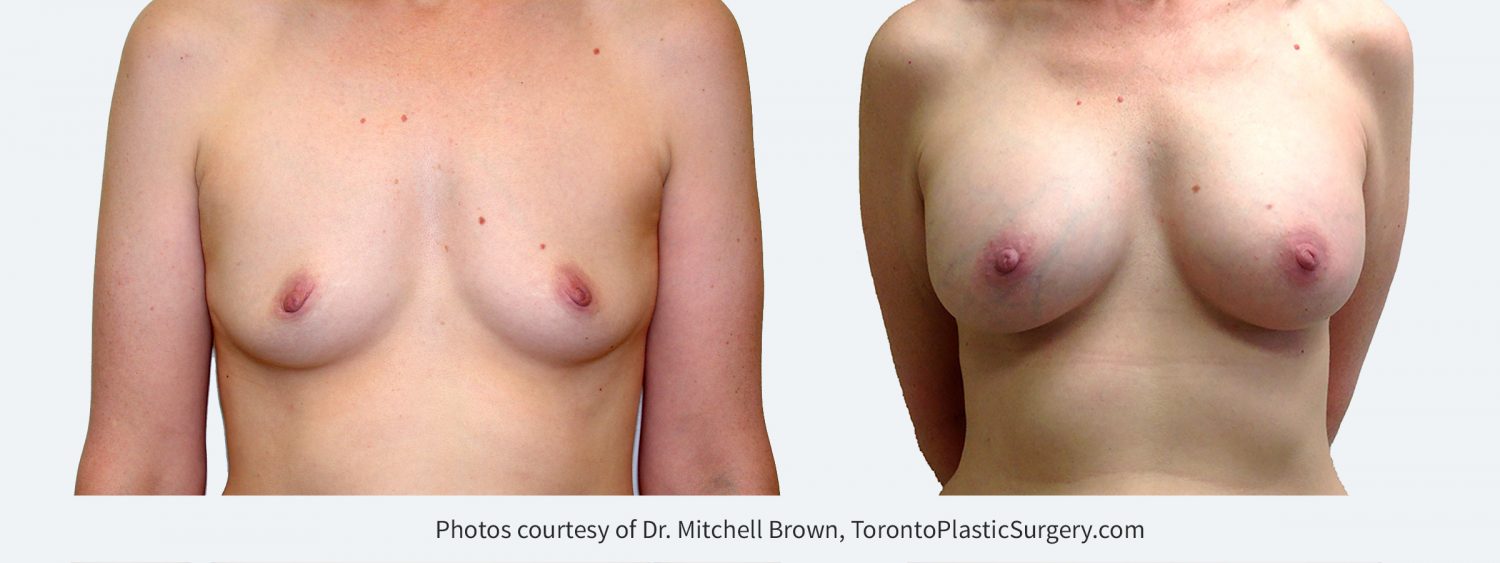 320 cc Silicone Gel Implants, Before and 14 Years After Surgery