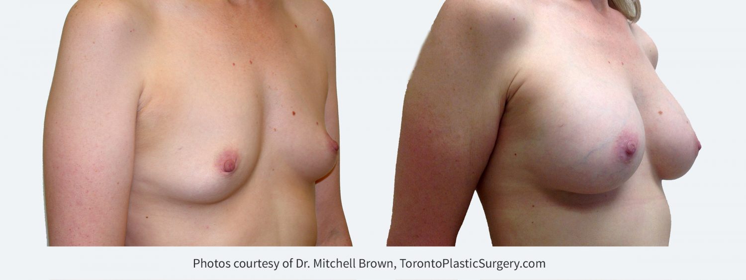 320 cc Silicone Gel Implants, Before and 14 Years After Surgery