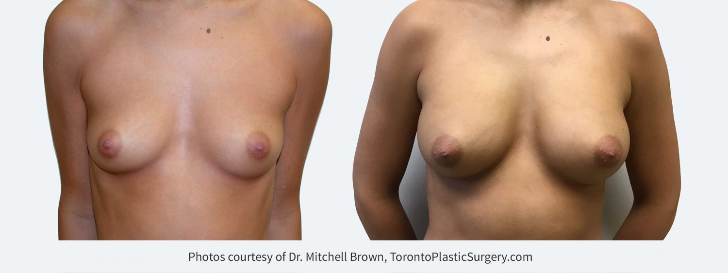 270 cc silicone gel implants, Before and 10 years after surgery