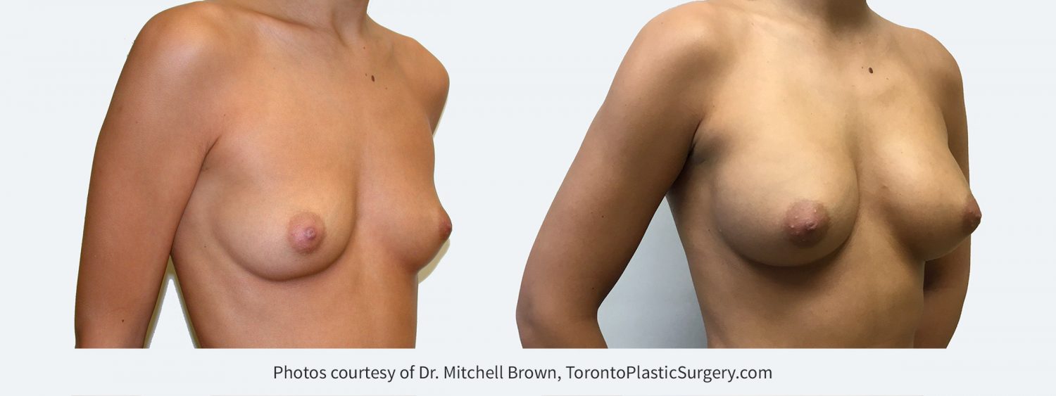270 cc silicone gel implants, Before and 10 years after surgery