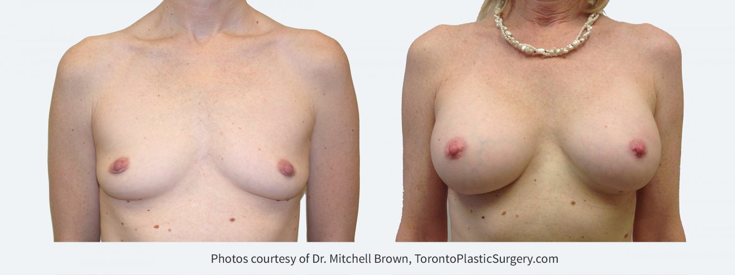 280 cc silicone gel implants, Before and 14 years after surgery