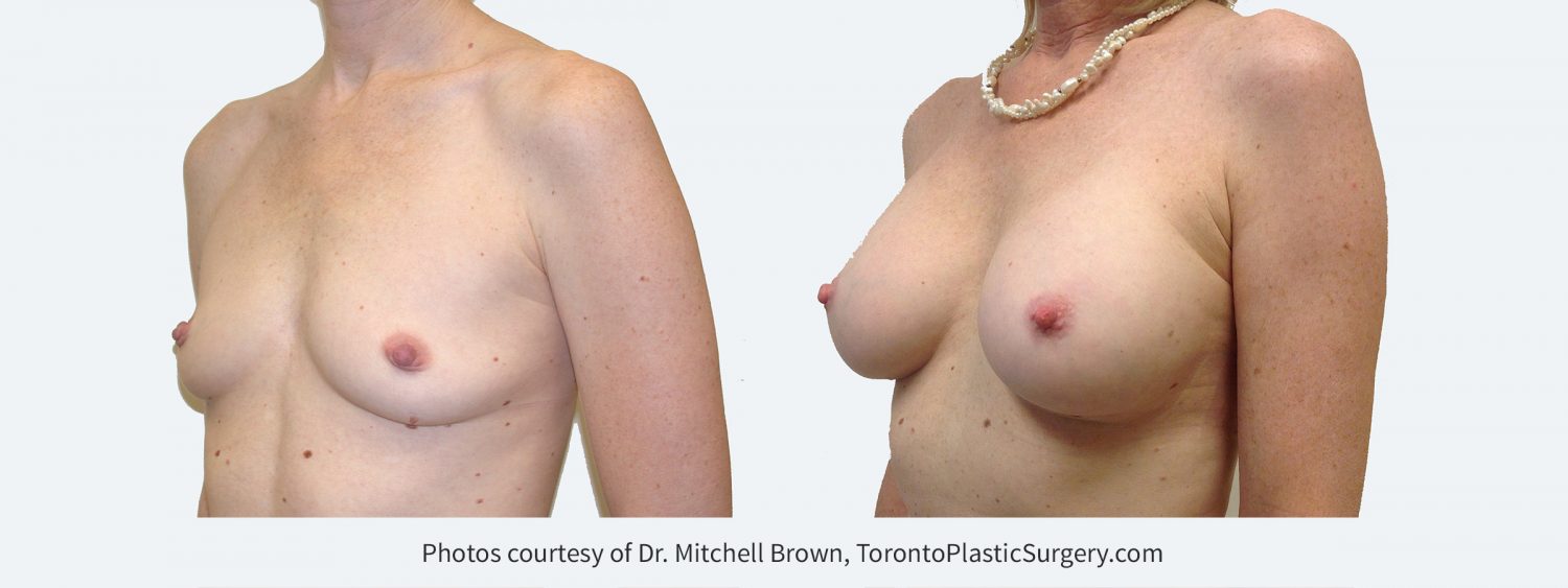 280 cc silicone gel implants, Before and 14 years after surgery