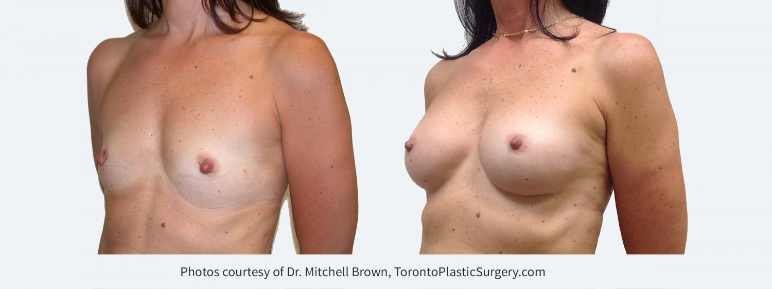 255 cc Cohesive Gel Implants, Before and 8 Years Post Surgery