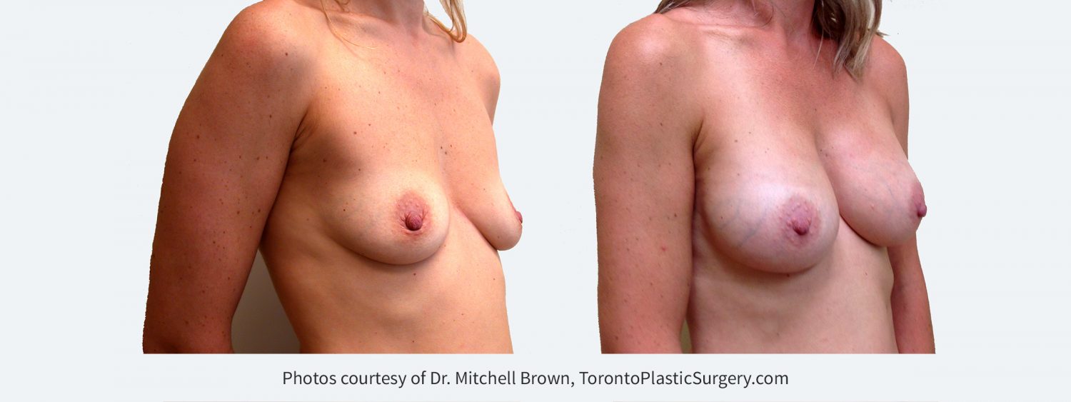 295 cc Cohesive Gel Implants, Before and 8 Years Post Surgery