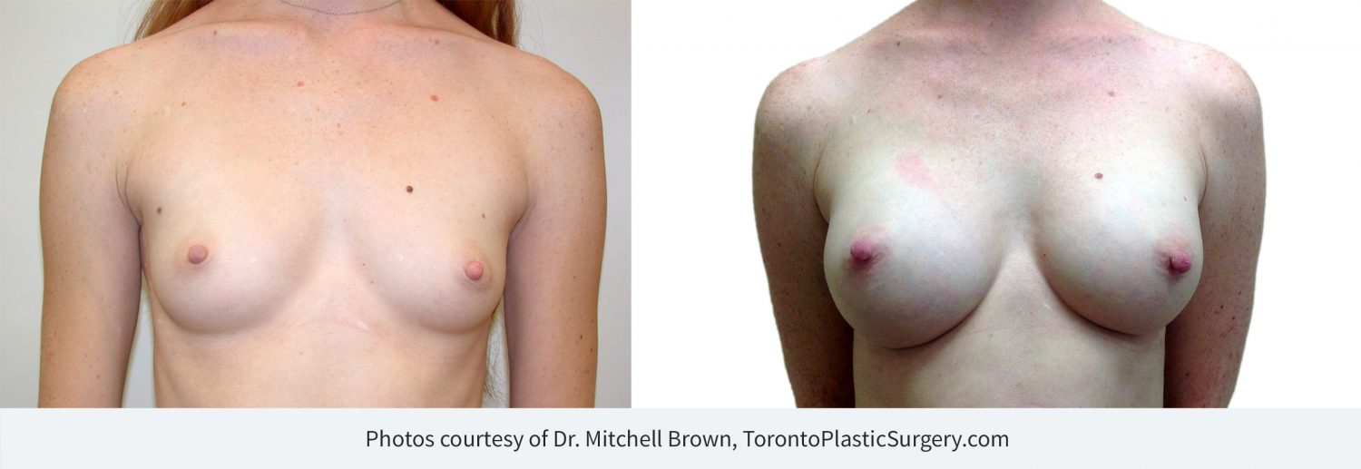 Breast augmentation with 265cc implants, before and after 13 years