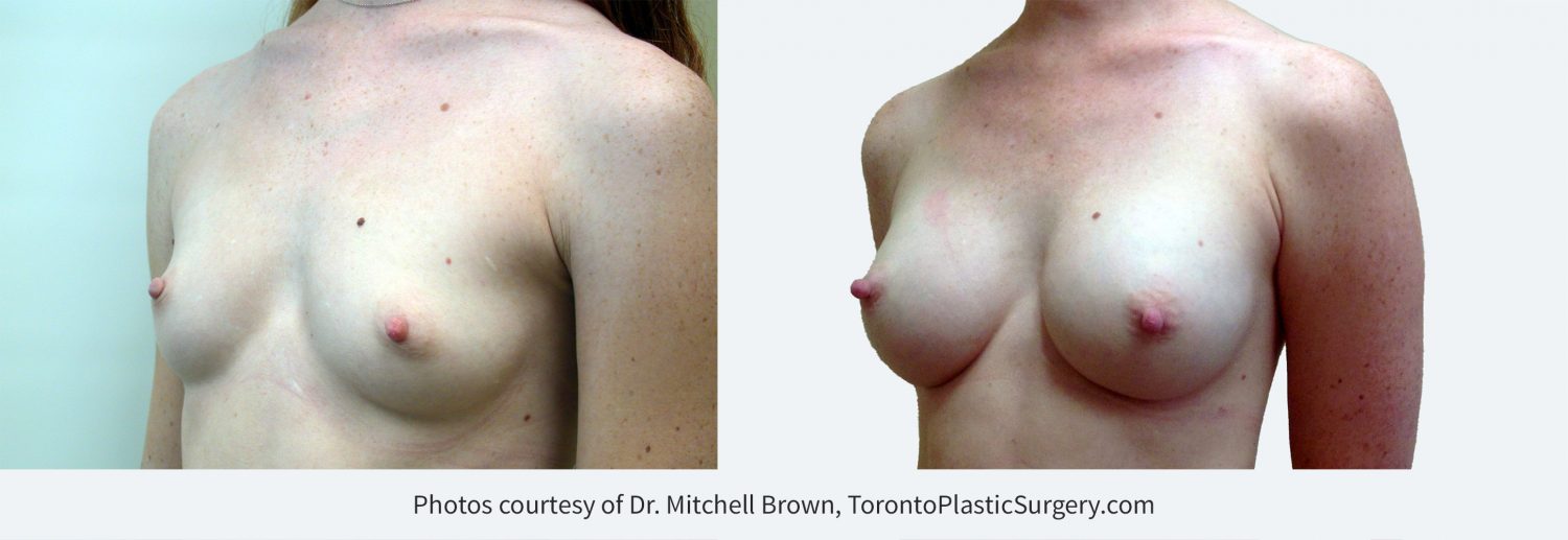Breast augmentation with 265cc implants, before and after 13 years
