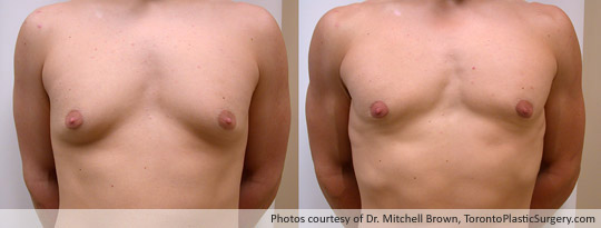Male Breast Reduction, Before and After 6 Months