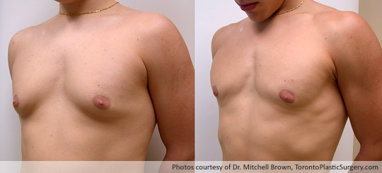 Male Breast Reduction, Before and After 6 Months