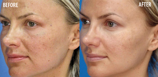 Microlaser Peel, Before and After