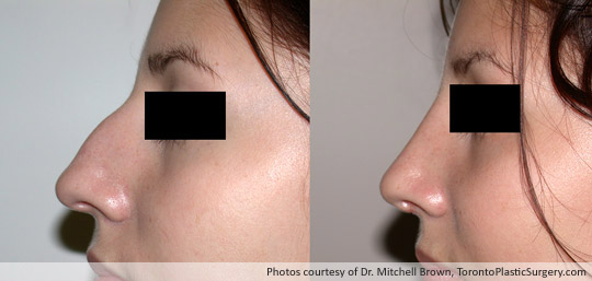 Rhinoplasty, Before and After 1 Year