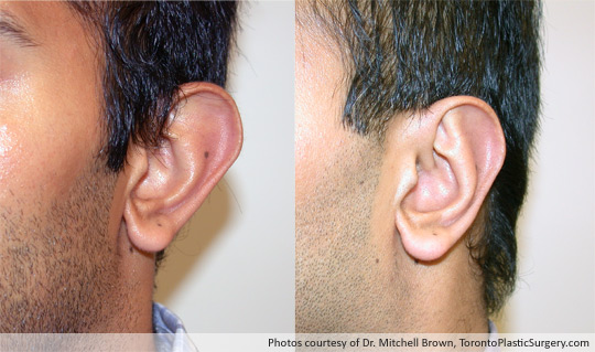 Otoplasty (“Ear Pinning”), Before and After