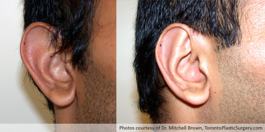 Otoplasty (“Ear Pinning”), Before and After