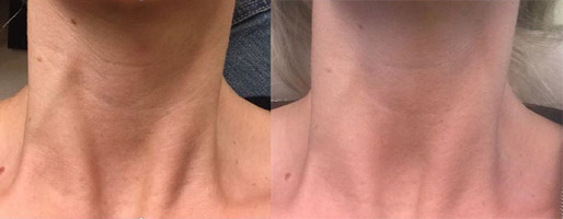 Profractional: 34yo female treated for neck lines, texture, and tightening. Before and after 4 months after a single Profractional laser neck treatment