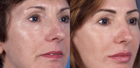 Profractional, Before and After