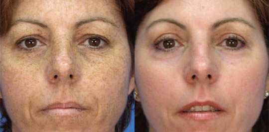 Profractional, Before and After