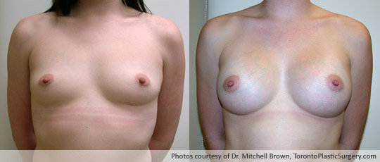 354gm Textured Round Gel Implant, Subpectoral Fold Incision, Before and After 6 Months